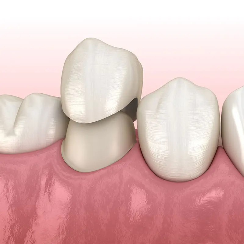 Dental crowns