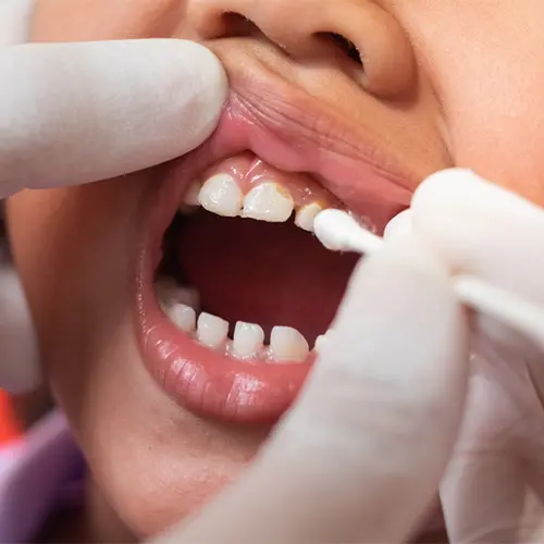 Fluoride treatment - Lake Sammamish Kids Dentistry
