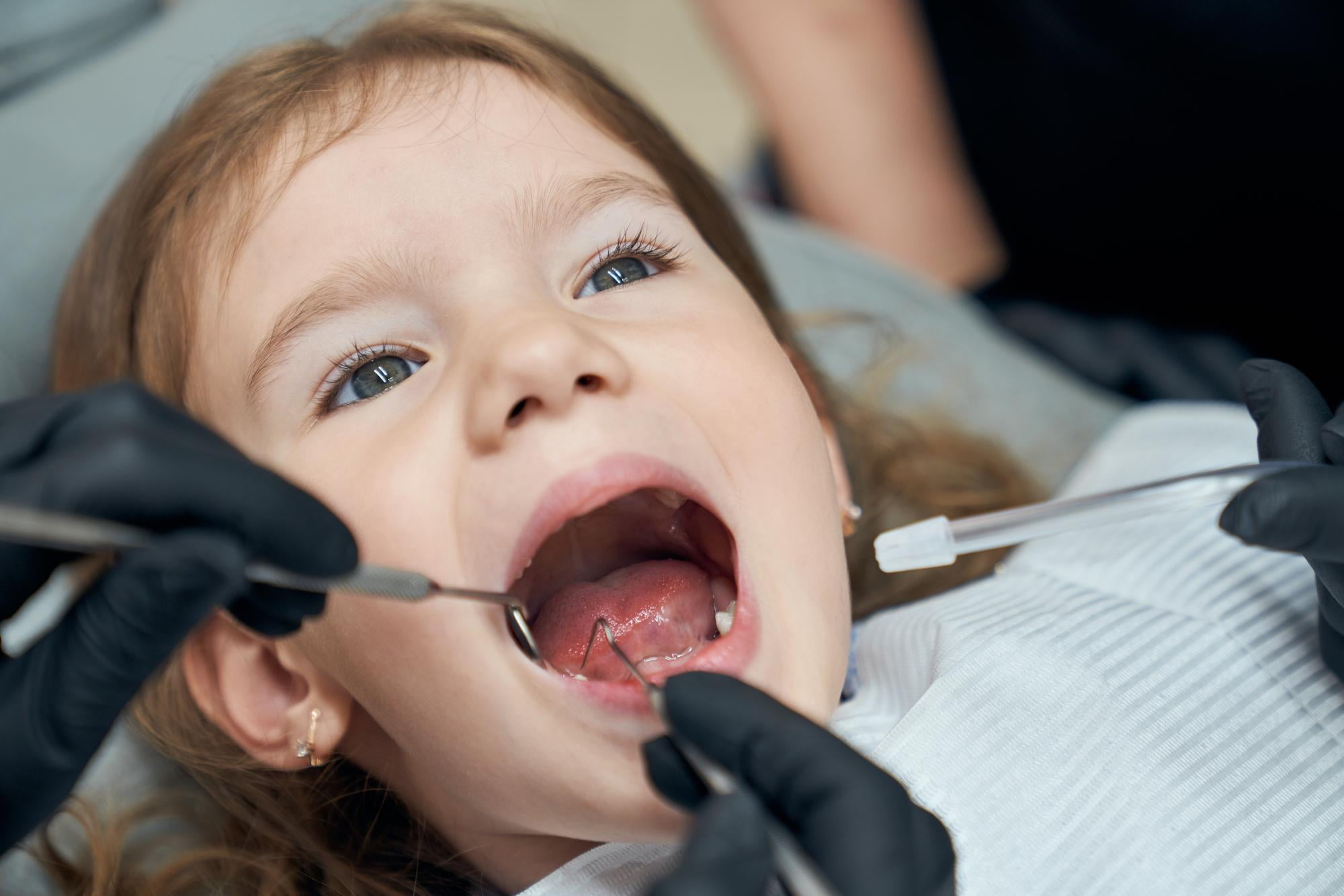 At Lake Sammamish Kids Dentistry - Pediatric Dentist in Sammamish, WA, a dentist wearing black gloves examines a young child's teeth, emphasizing the importance of early orthodontics and partnering with local orthodontists to ensure healthy smiles.