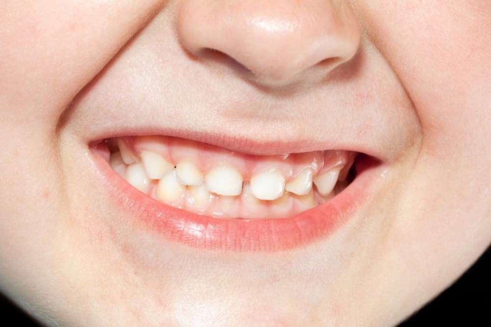 A child's smile with uneven, crowded baby teeth at Lake Sammamish Kids Dentistry in Sammamish, WA.
