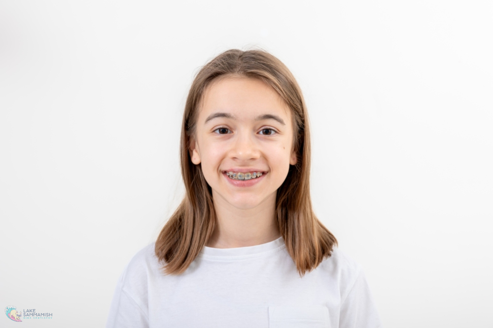 Smiling young person with long hair and braces, in a white shirt, at Lake Sammamish Kids Dentistry in Sammamish, WA - Braces for Teens in Sammamish: What Parents Should Know
